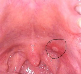 喉咙长泡是什么病图片 斗图表情包大全 - 与 喉